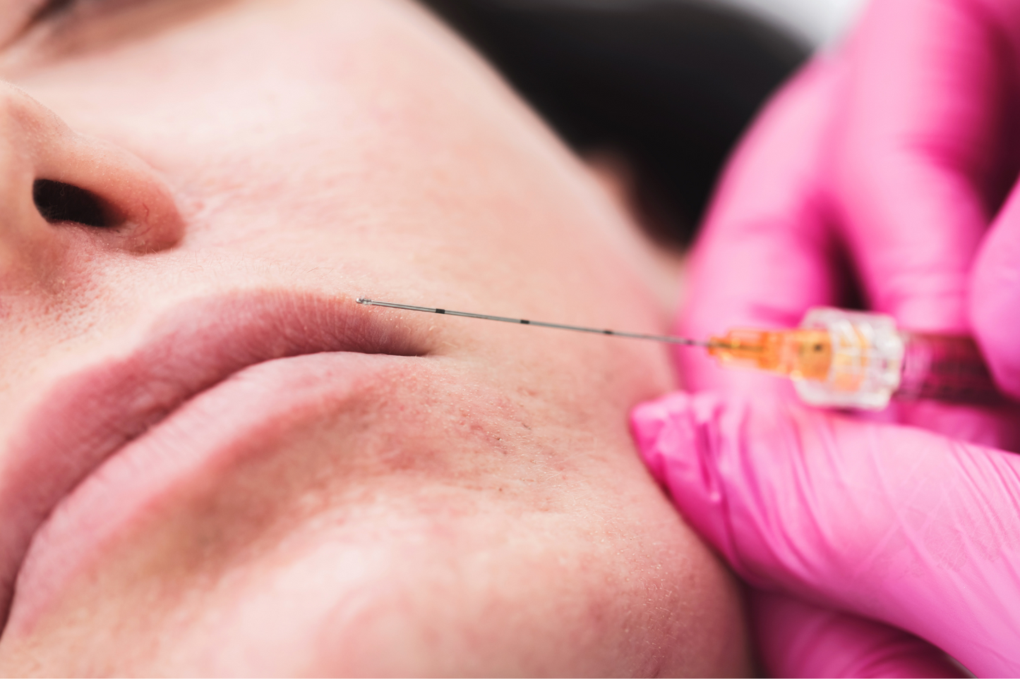 Dermal Filler